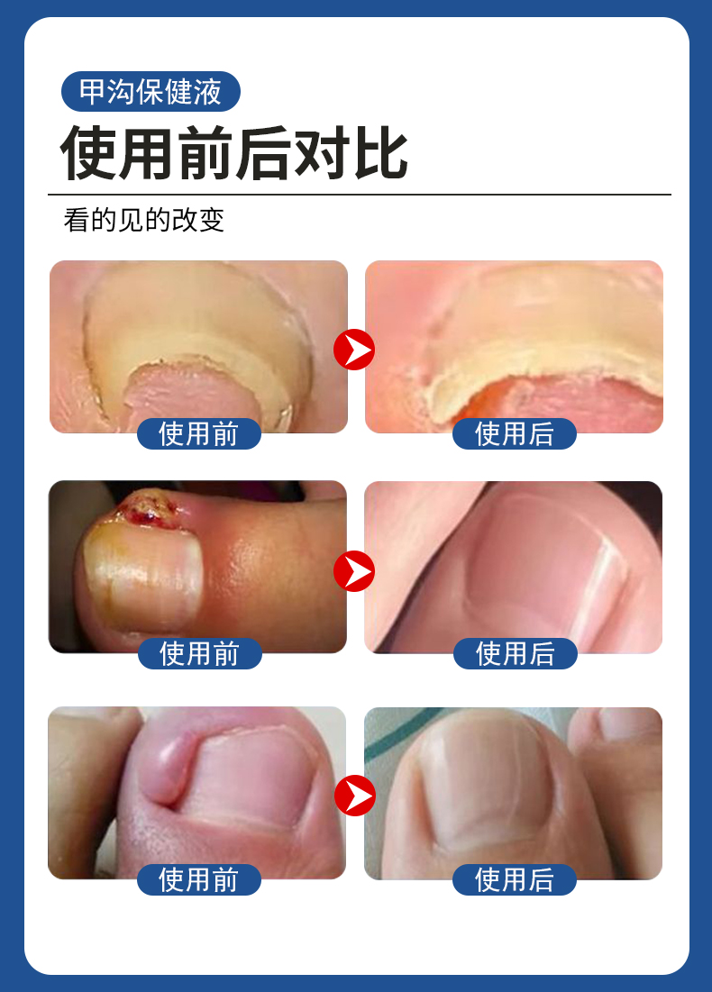 甲溝炎專用液有用嗎？使用前后對比